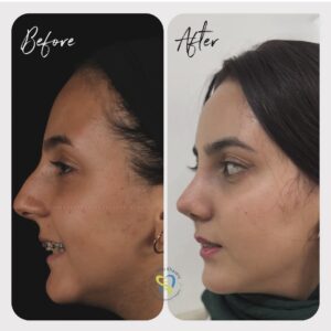 جراحي زيبايي بيني