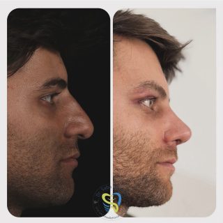 جراحي زيبايي بيني (4)