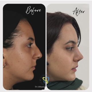 جراحي زيبايي بيني (6)