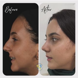 جراحي زيبايي بيني